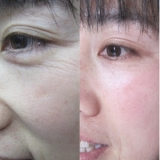 JNS22+40days